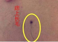痣上长毛代表什么运势?